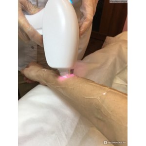 Лазерная эпиляция фото