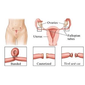 На что влияет перевязка труб у женщин боль в нижних ребрах справа сзади со спины