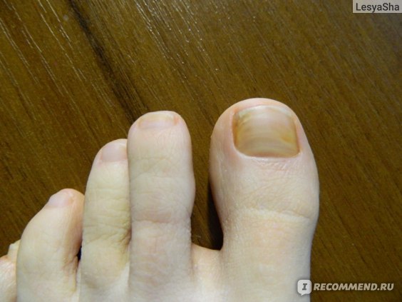 Грибок Ногтя Большого Пальца Ноги Фото