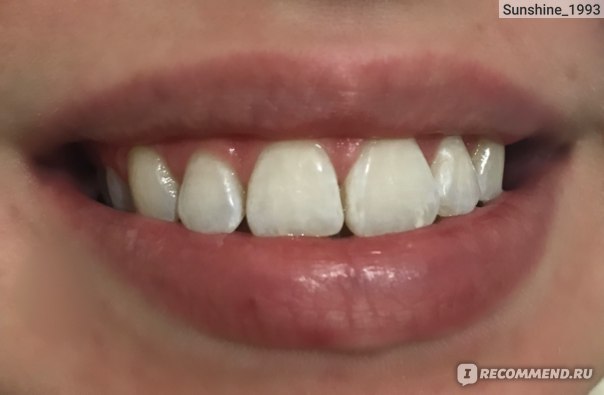 отбеливание зубов ачинск