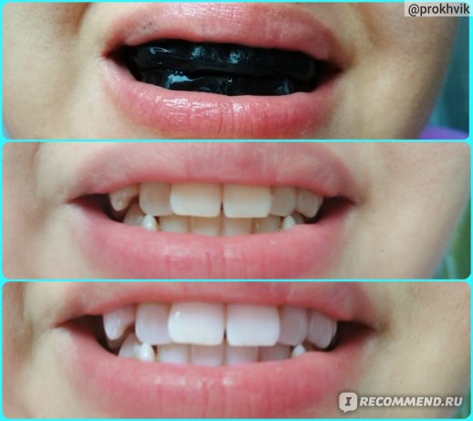 отбеливание зубов черным углем отзывы