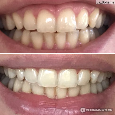 отбеливание зубов капой до и после