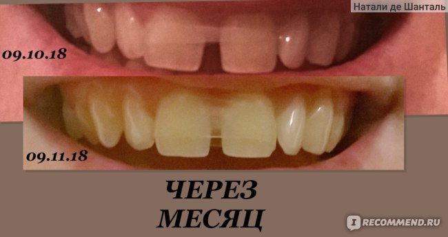 Восстановление испорченного супер клеем переднего зуба вкладкой CEREC