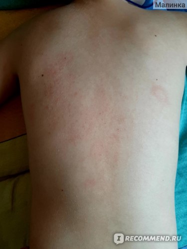 Аллергия На Пантогам