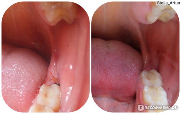 Иссечение капюшона зуба мудрости Томск Больничная регистратура стоматология детская 1 томск