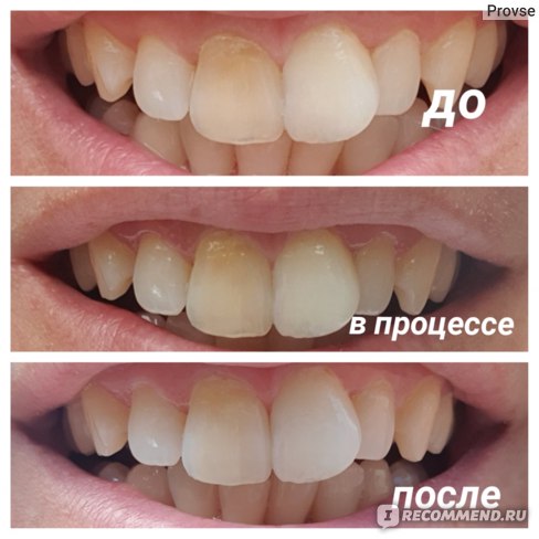 Как выглядят зубы после отбеливания Внутриканальное отбеливание зубов (Эндоотбеливание) - "На мне метод сломался." о