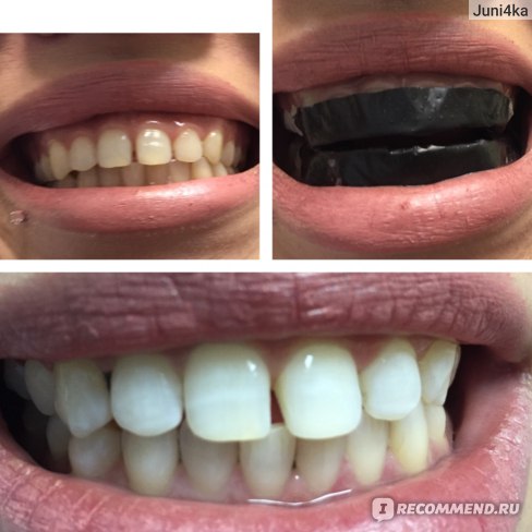 фото до и после отбеливания зубов углем