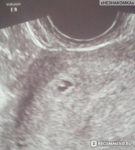 Фото Эмбриона 5 Недель Беременности Узи