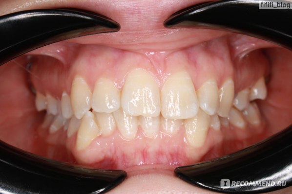 Удаление зубов мудрости перед установкой брекетов: зачем проводят и как подготовиться к операции