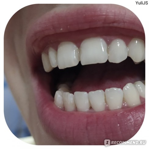 зубы пятнами после отбеливания зубов