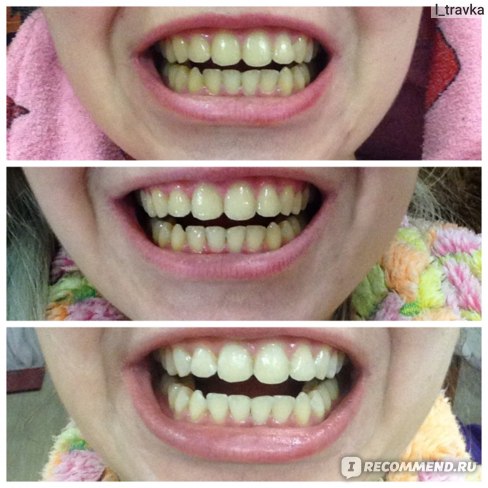 отбеливание зубов дома отзывы и фото