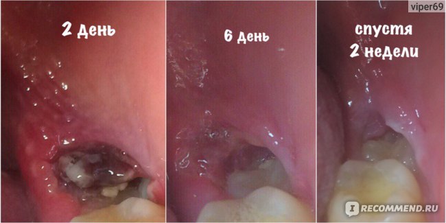 Иссечение капюшона зуба мудрости Томск Калужский томск стоматология качественно и недорого
