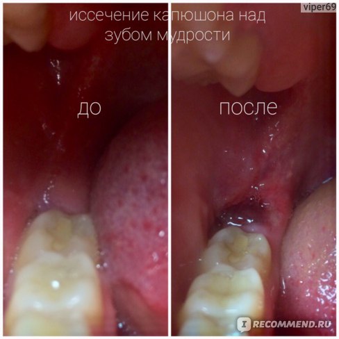 Иссечение капюшона зуба мудрости Томск Доверия томск детская стоматология бесплатно