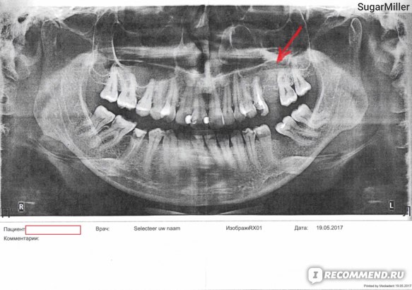 Лечение одонтогенного гайморита, вызванного не леченными зубами