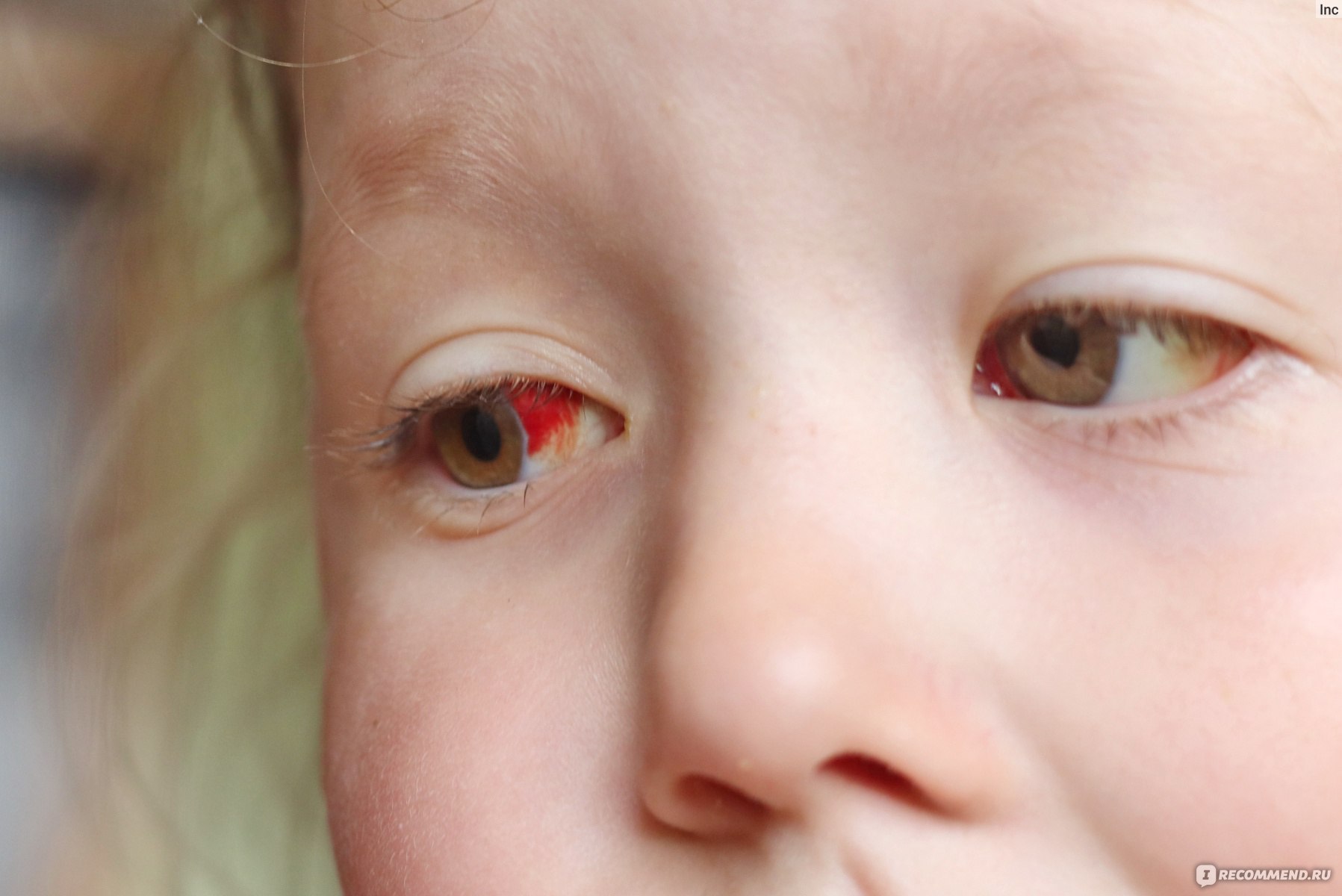 Капли для глаз Тобрисс - «Тобрисс при остром коньюктивите у ребенка 3-х .