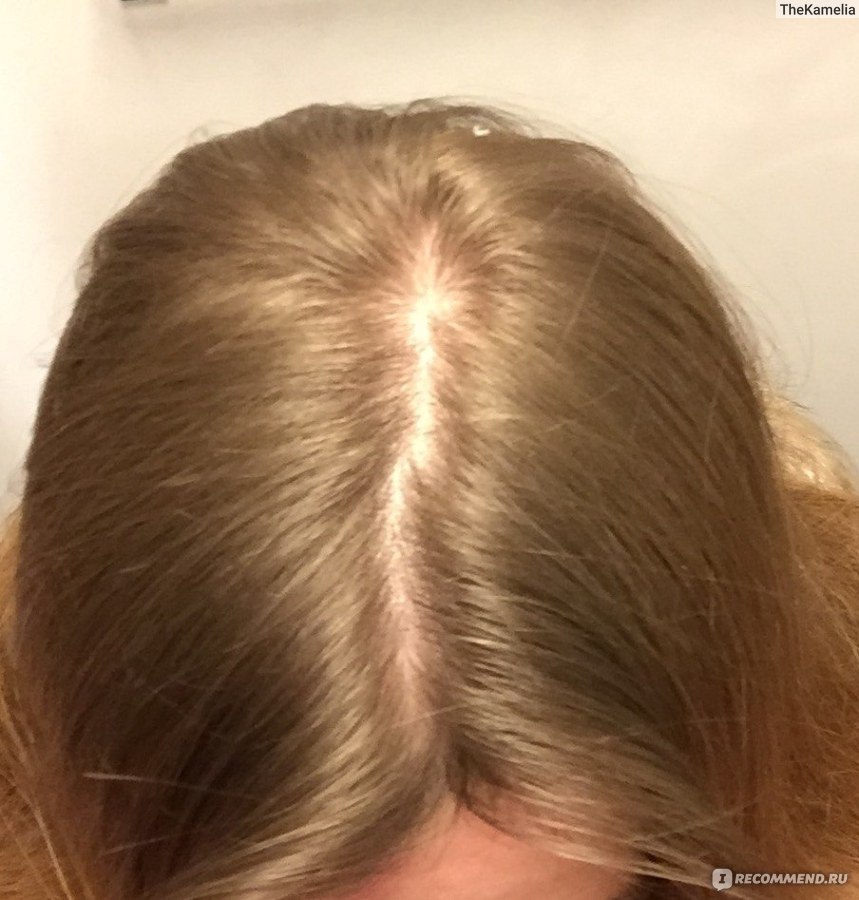 Аэрозоль Регейн 5% миноксидил - «Настоящее спасение при выпадении волос .